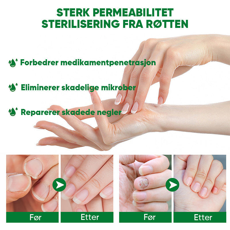 Ingefær neglebehandling