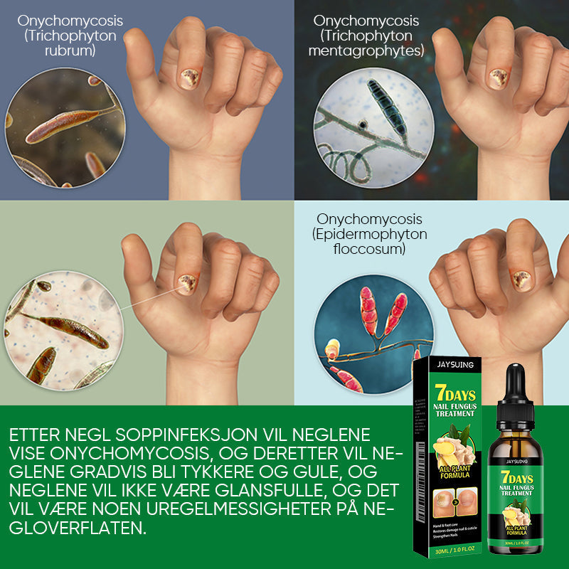 Ingefær neglebehandling