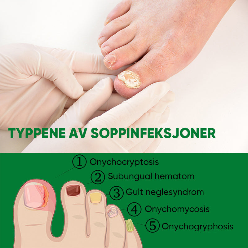 Ingefær neglebehandling